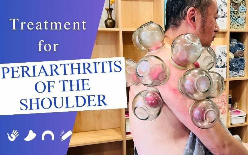 TCM External Treatments for Periarthritis of the Shoulder1